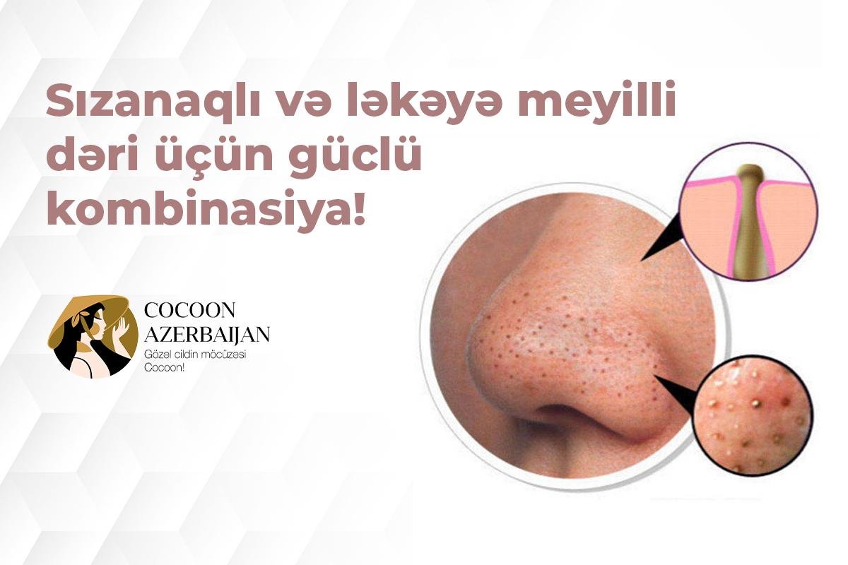 Sızanaqlı və ləkəyə meyilli dəri üçün güclü kombinasiya!